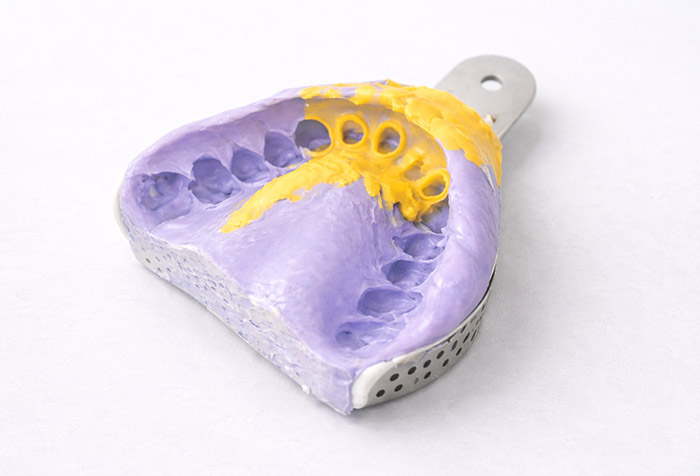 形成・印象（型取り）のイメージ