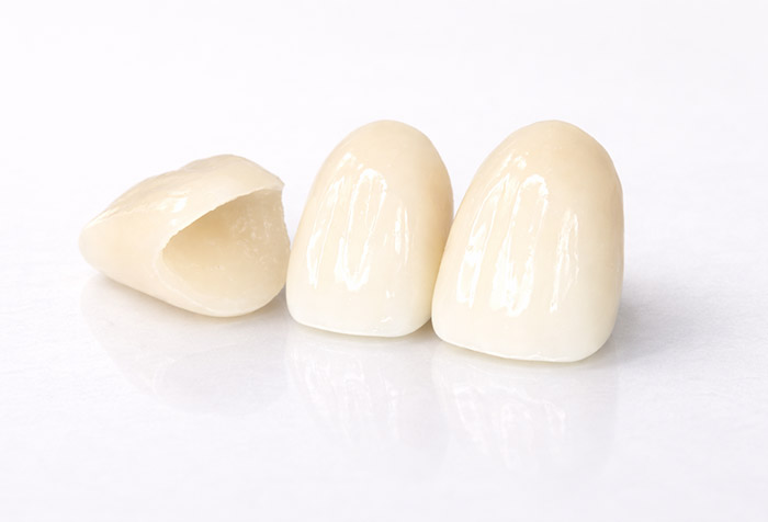 仮歯のイメージ